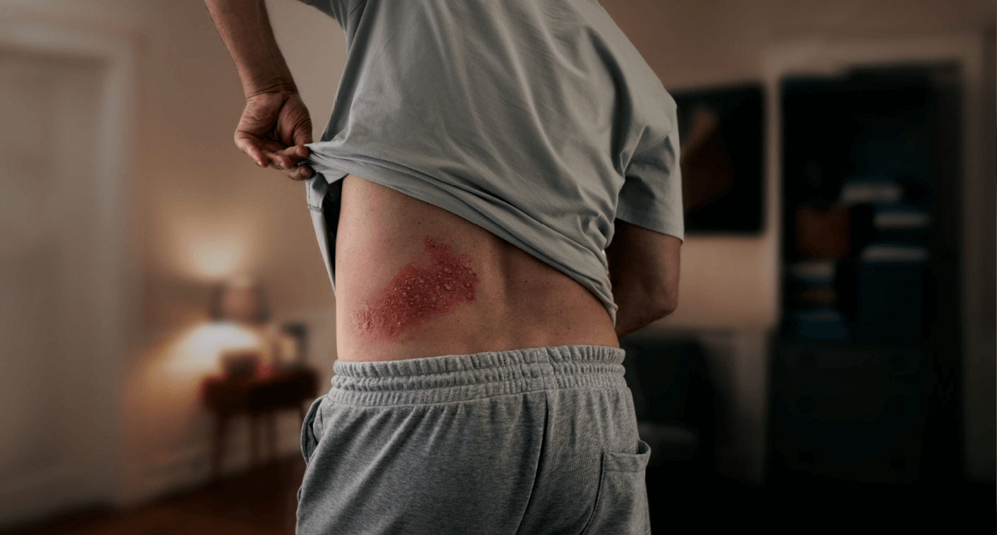 Shingles Rash on Back