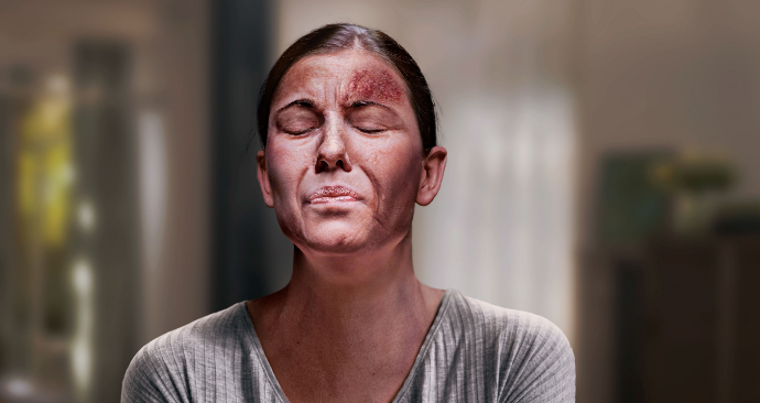 Shingles Rash on Face
