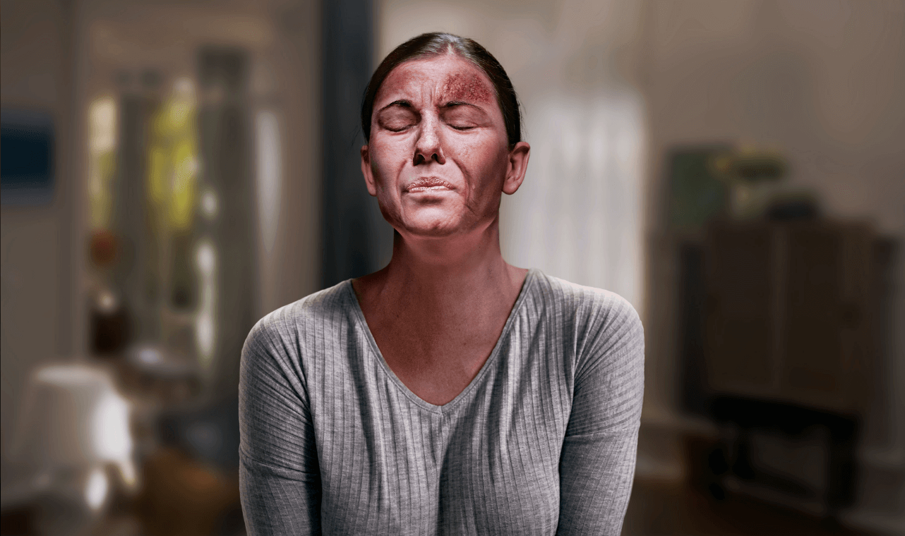 Shingles Rash on Face
